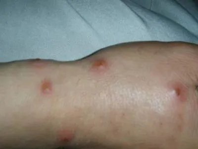 蚋叮咬引起的皮肤反应水疱图片