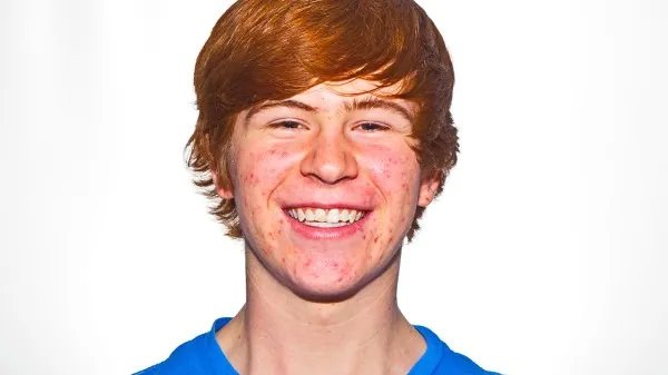 祛痘护肤时有哪些注意事项？男人祛痘用这3个小妙招