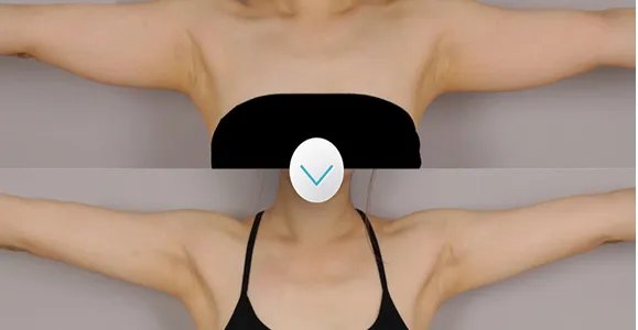 手臂吸脂减肥恢复多久