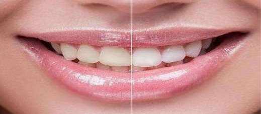 怎样让牙齿变白小窍门