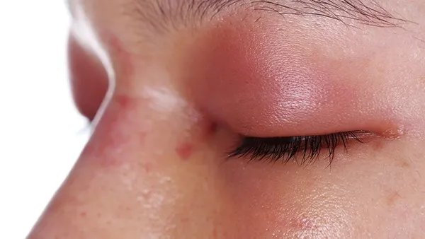 透明质酸隆鼻手术的注意事项