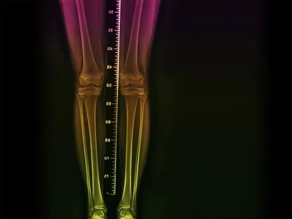 国家明文禁止的增高方法，手术者面临终身残疾