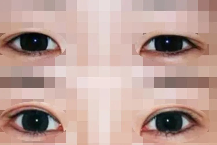 割双眼皮对比图