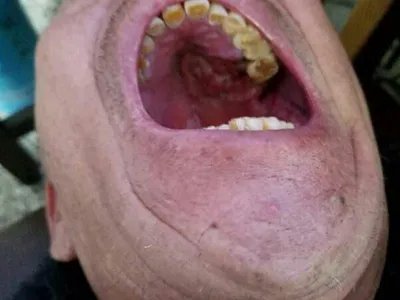 上颌窦癌症状图片