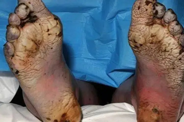 战壕足症状图片