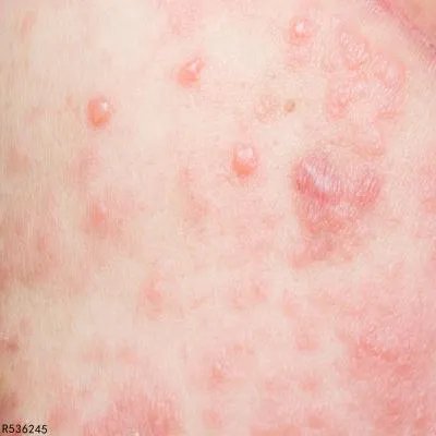 痤疮的症状主要都有哪一些呢