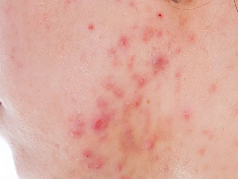 脸上长痘痘的位置代表着什么