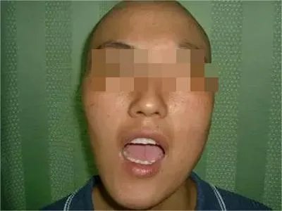 上颌窦癌症状图片