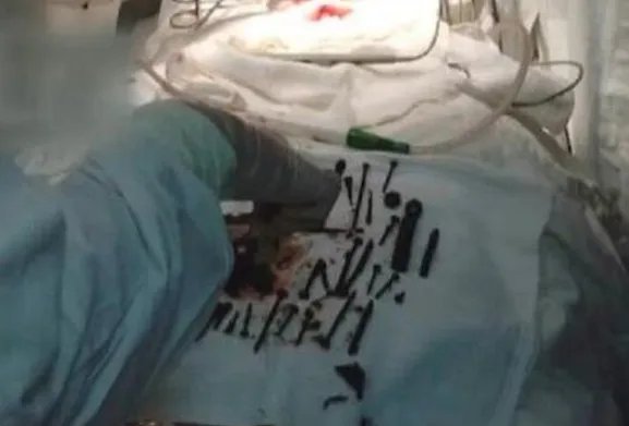 俄罗斯一老太为何会吞下1公斤铁钉？