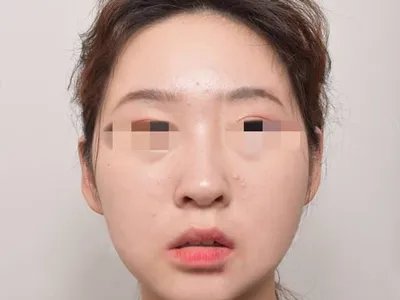 上颌窦癌症状图片