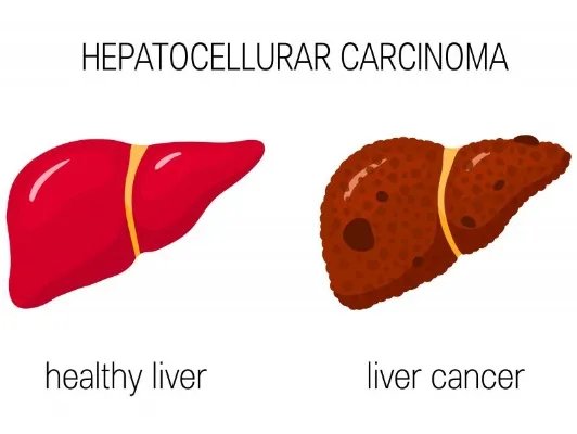 抗肝癌药物有哪些