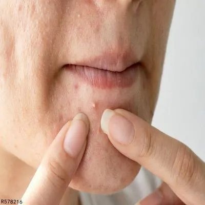 白头粉刺应该怎么去除