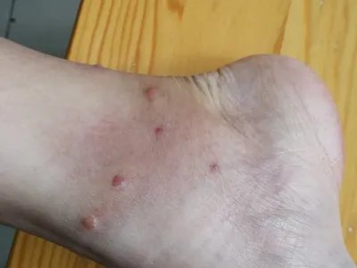 蚋叮咬引起的皮肤反应水疱图片