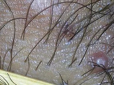 外阴毛囊炎大疙瘩图片