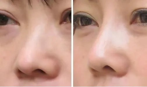 韩式三段和两段哪种隆鼻好