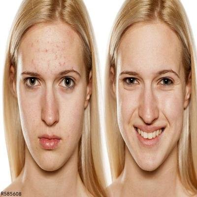 长了聚合性痤疮要怎么办