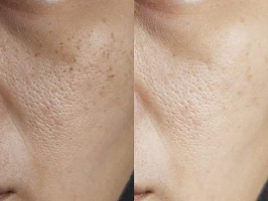 黄褐斑能点掉吗