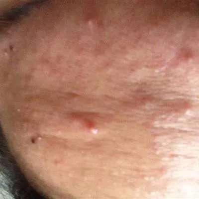 男士怎么祛痘痘