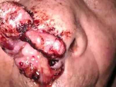 上颌窦癌症状图片