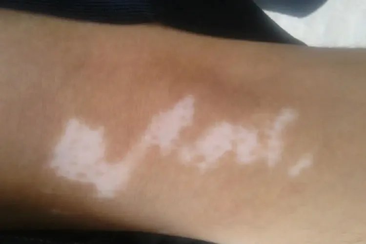 儿童胳膊上有白斑图片大全