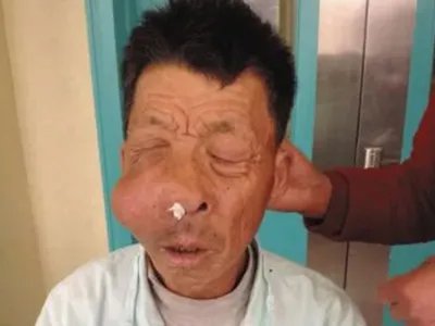 上颌窦癌症状图片